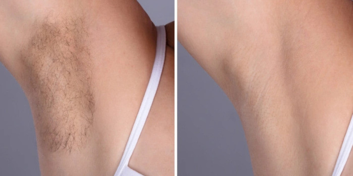 Laser hair removal in Dubai: Cost, Sessions, and Results