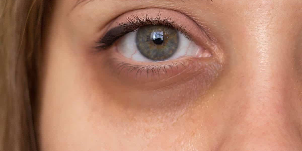 Revitalize Droopy Eyelids with Surgery: Step-by-Step Journey to Brighter Vision