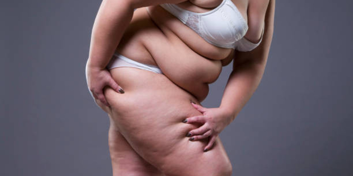 Lipedema Treatment Solutions for Reducing Discomfort Naturally