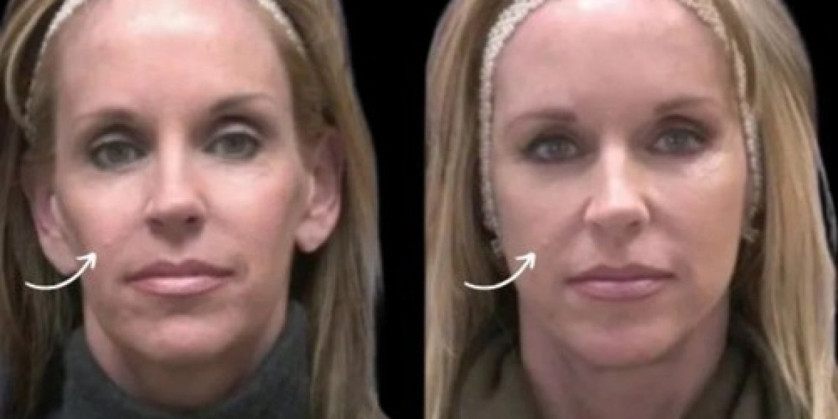 Best Doctors in Dubai Explore Sculptra Fillers for Stretched Earlobes