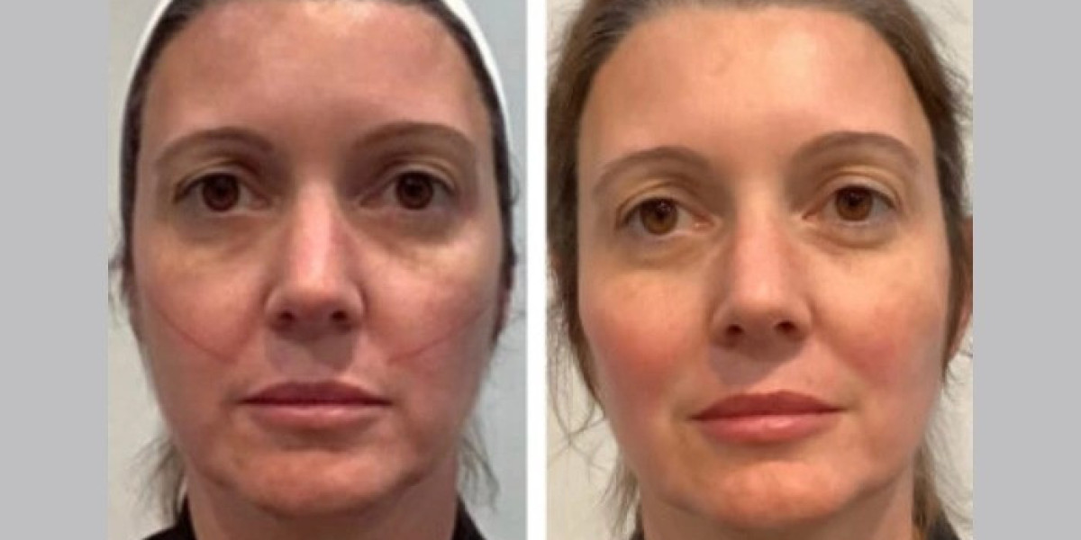 Best Doctors in Dubai known for Thread Lift Procedures with Excellent Results