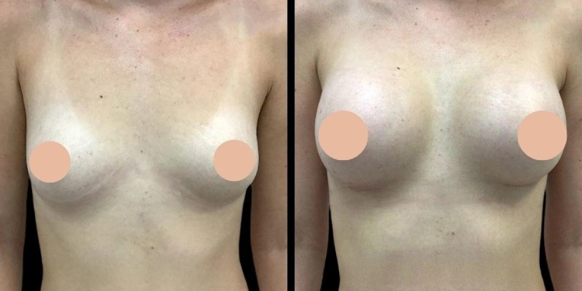 Breast Augmentation in Dubai: Safety Measures and Modern Techniques