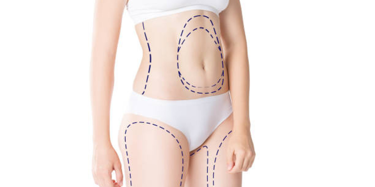 Liposuction for Targeted Fat Removal Success