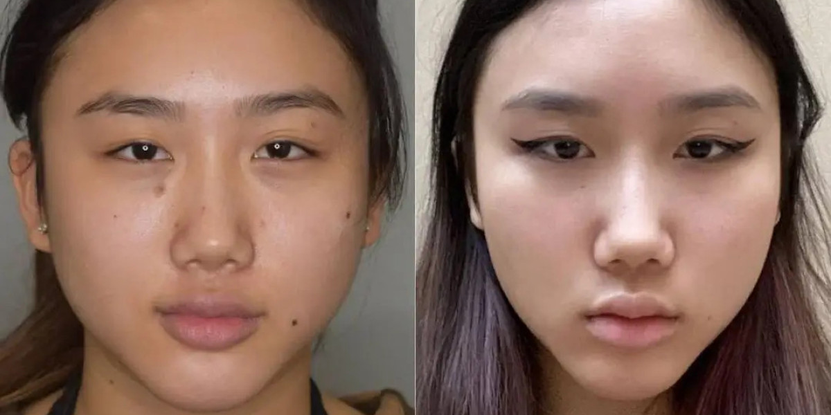 Buccal Fat Removal Cheek Definition Best Doctors in Dubai