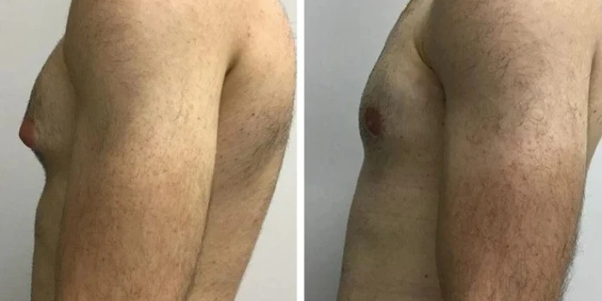 Gynecomastia in Dubai: Modern Clinic Prioritize Patient Safety Satisfaction