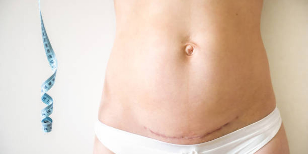 Mommy Makeover Procedures for Renewing Your Postpartum Figure