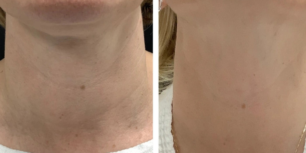 Radiofrequency (RF) Microneedling Treatment in Dubai for Improved Skin Resilience