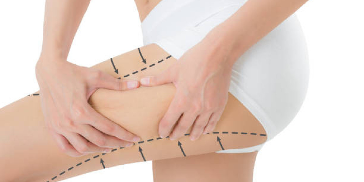 Common Side Effects After Liposuction