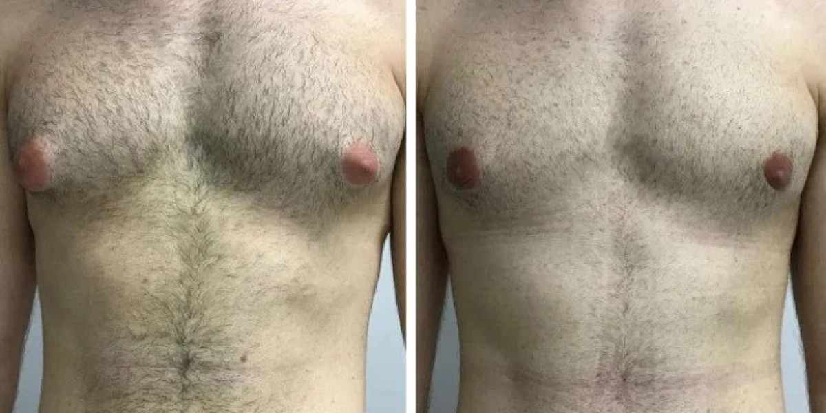 Glandular Tissue Removal With Best Gynecomastia Surgeons in dubai