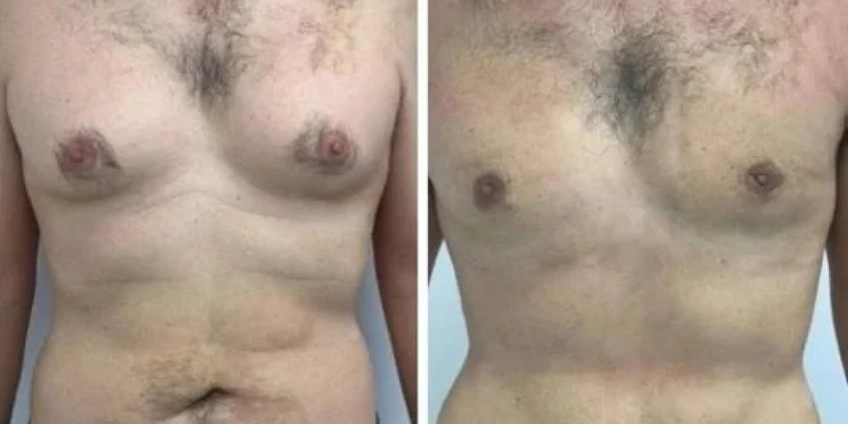 Best Gynecomastia Surgeons in Dubai: Finding Expert Care