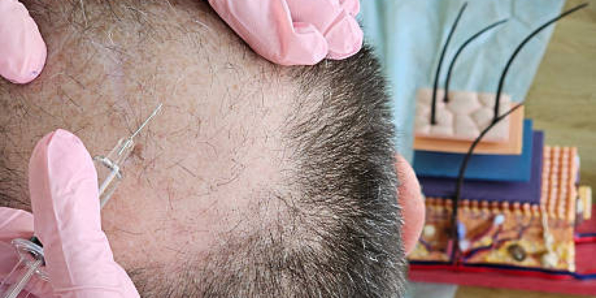 Scalp Micropigmentation in Dubai for Receding Temples Guide