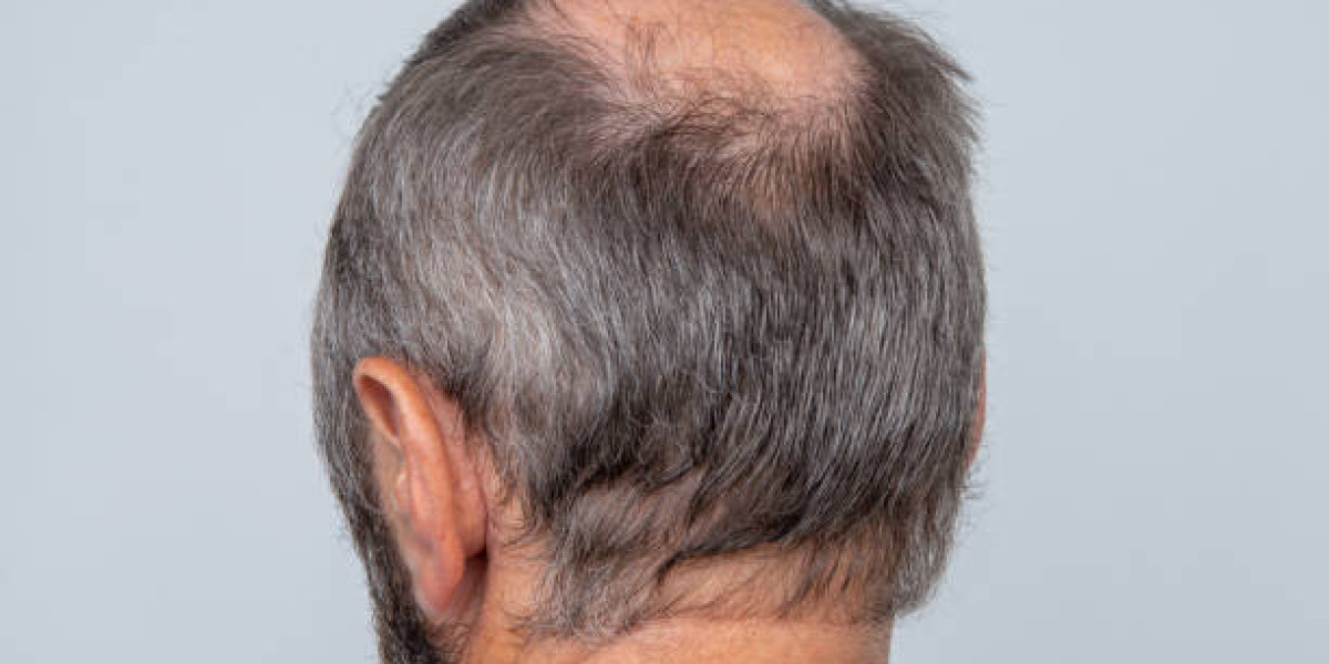 Can FUE Hair Transplant in Dubai Treat Early Crown Thinning?