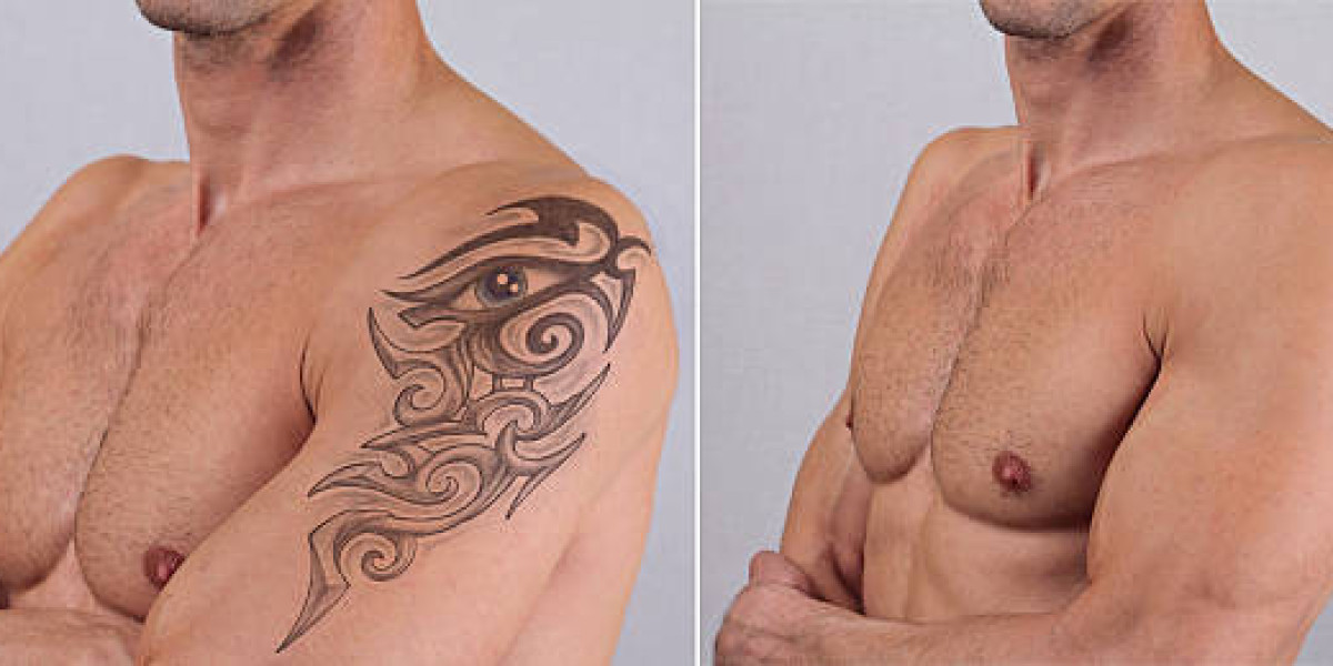 Exploring Advanced Approaches to Laser Tattoo Removal Treatment